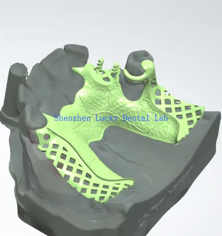 3D Proizvođači ispisa zubnih metala