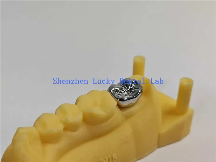 3D ispis visokokvalitetnog zubnog FMC -a puna metalna kruna