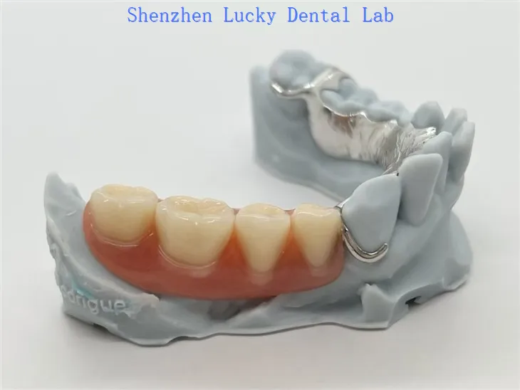 3D print metalni Co Cr okvir s akrilnom protezom