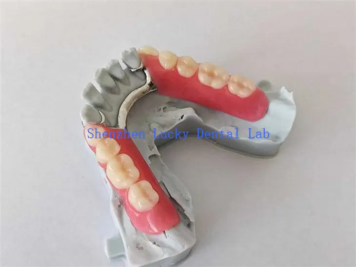 3D ispis djelomična akrilna proteza s metalnim okvirom pokušajte u zubnom laboratoriju