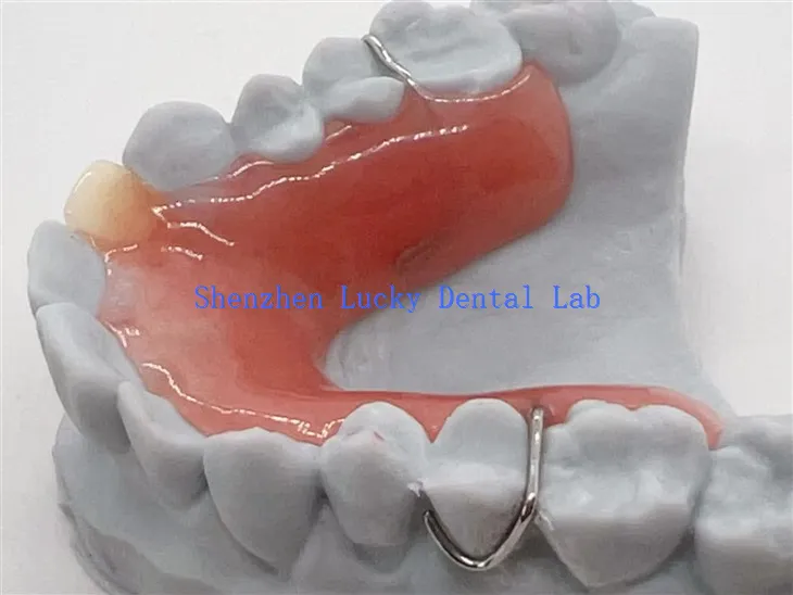 3D ispis uklonjive djelomične proteze s akrilnom bazom