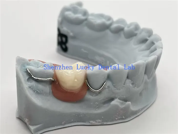 3D ispis jednostrane akrilne proteze