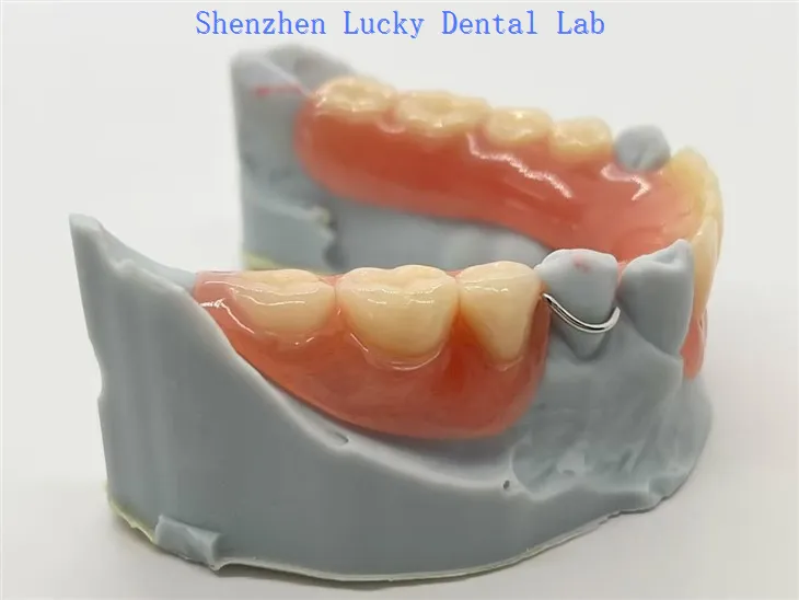 Akrilna uklonjiva djelomična proteza sa žicom kopča