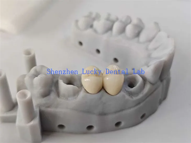 Estetski zubni pfm cocr most