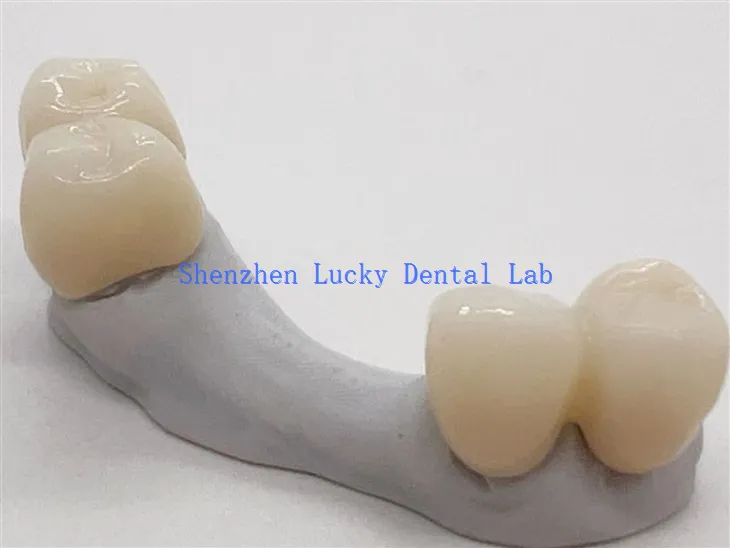 Estetski dentalni cirkonski most