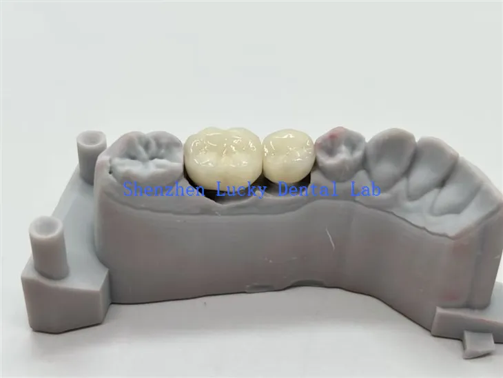 Zubne krunice od CoCr legure PFM