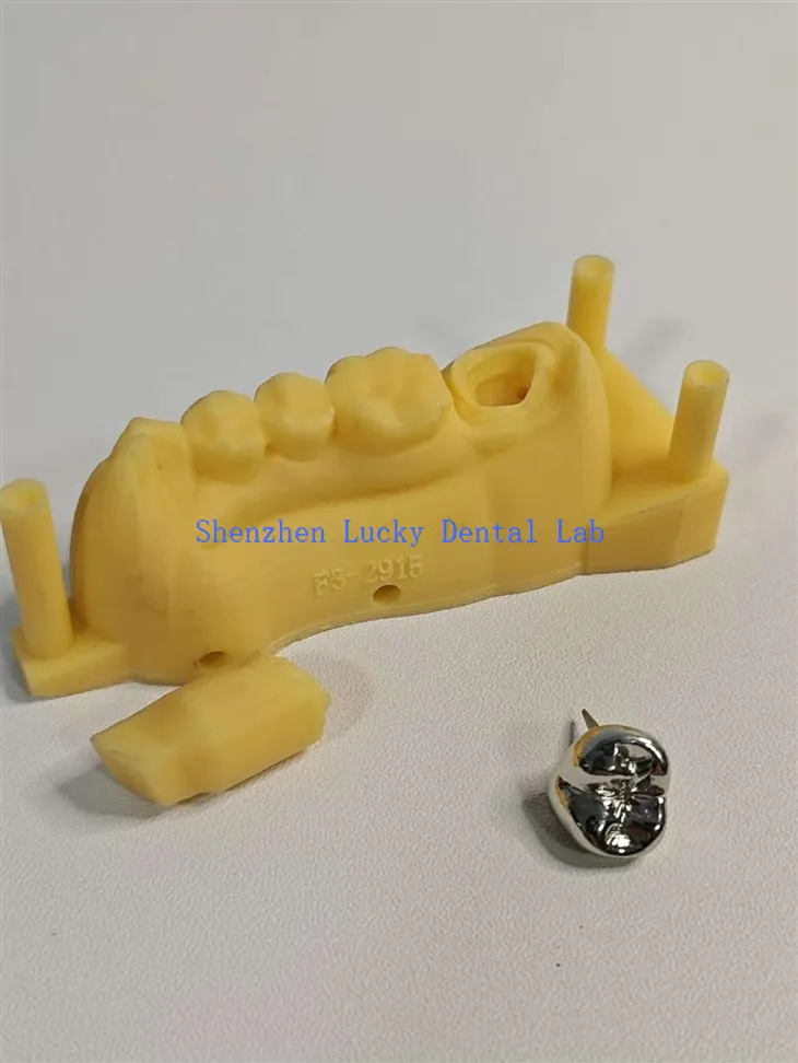 Prilagođeni 3D ispis zubni FMC puna metalna kruna