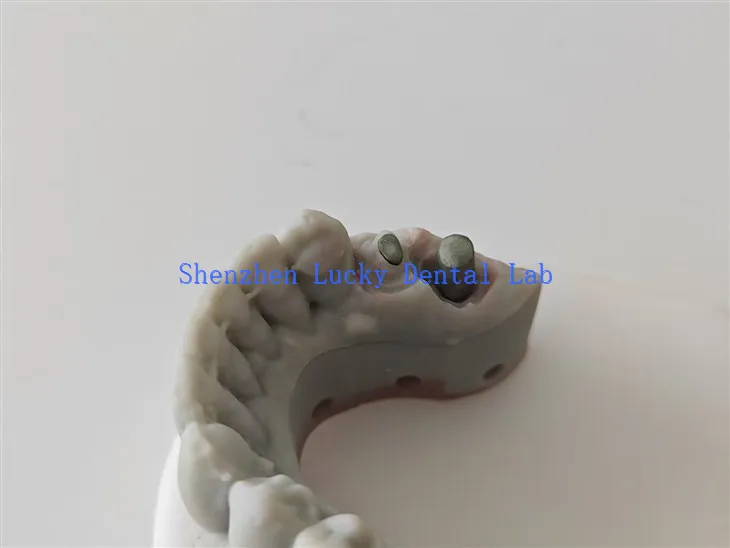 Prilagođeni 3D ispis stomatološkog stomatološkog laboratorija