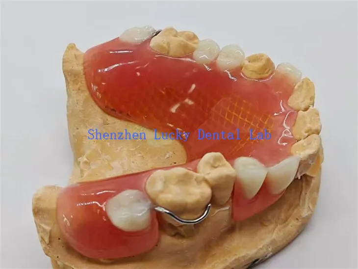 Uklonjiva djelomična proteza s metalnom mrežom