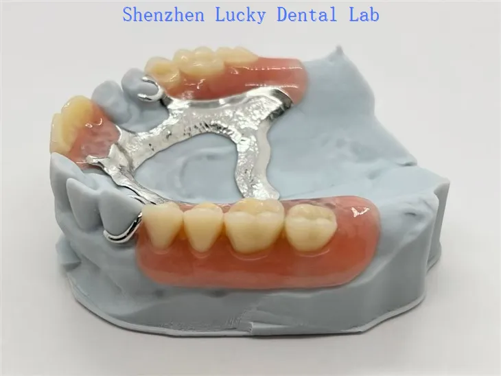 Zubni metalni okvir-u obliku potkove