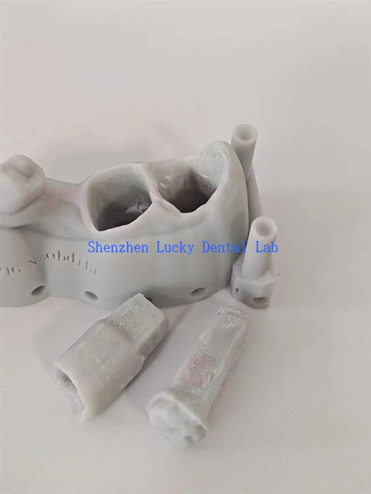 Dental Removable Die