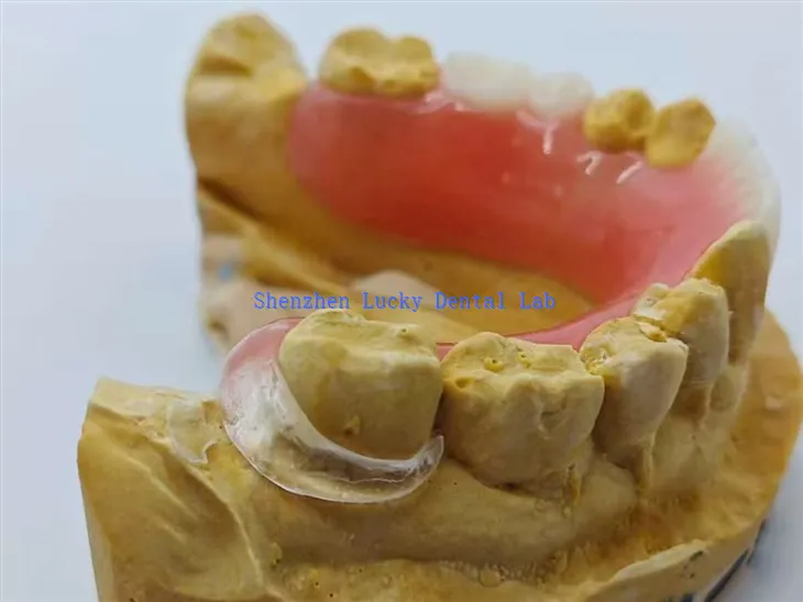 Akrilna proteza s prozirnom kopčom