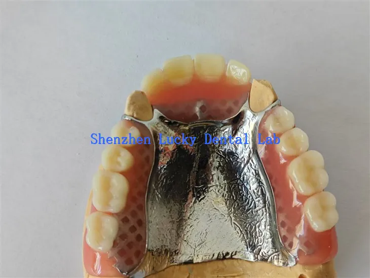 Velika djelomična akrilna proteza s metalnom palatalnom pločom zubni laboratorij