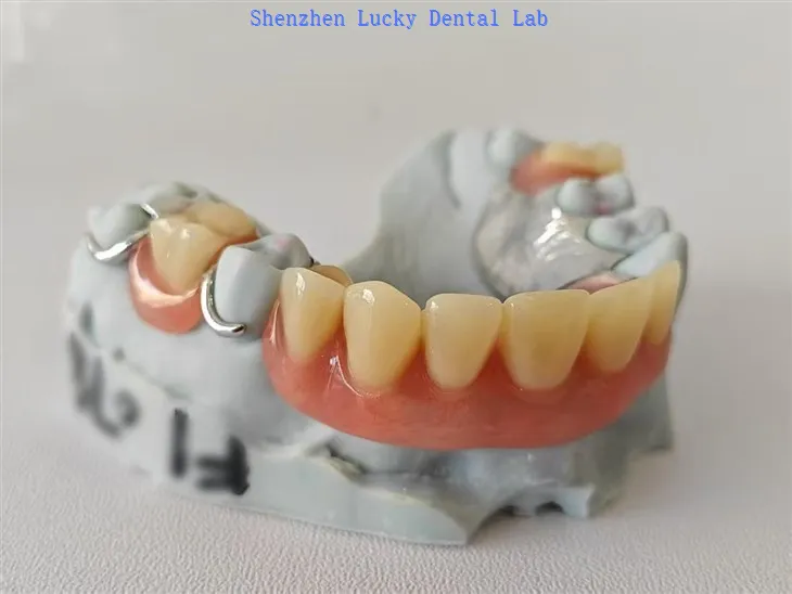 Djelomična akrilatna proteza s metalnim okvirom od žičane kopče