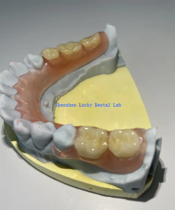 Djelomična fleksibilna proteza