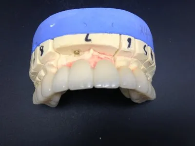 Visokoprecizna dentalna potpuno keramička krunica od cirkonija