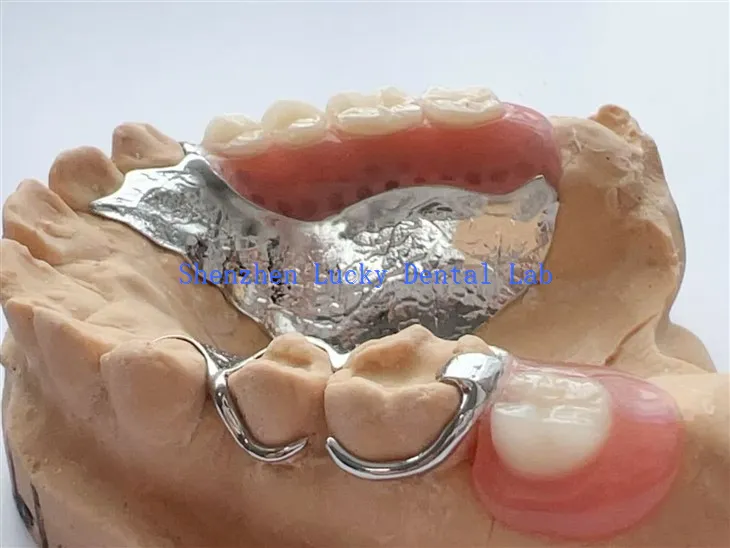 Žice kopče zubni metalni okvir s djelomičnom akrilnom protezom